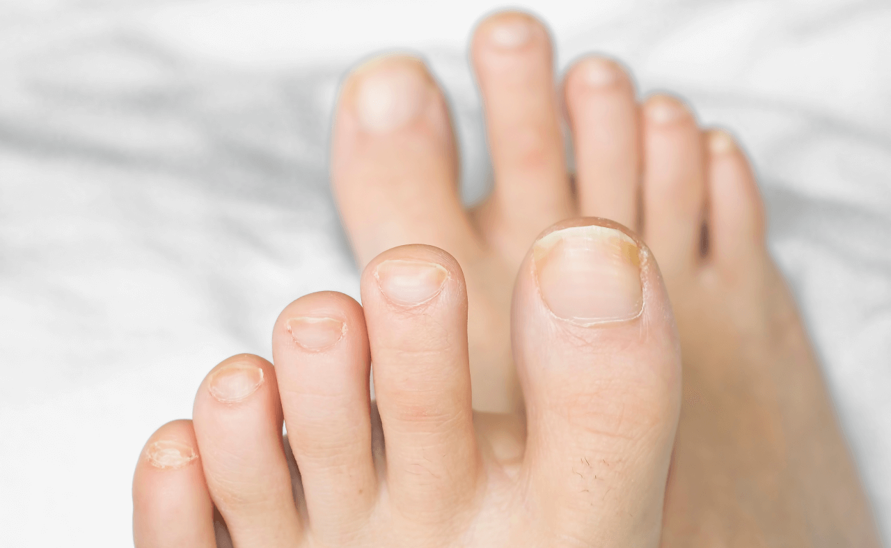 Грибок ногтей: течение, лечение у взрослых и детей